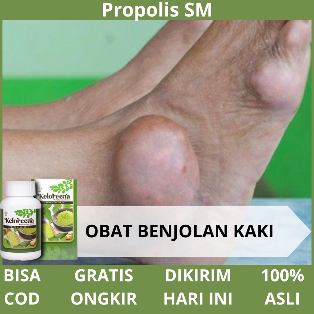 Obat Benjolan Di Kaki - Penghilang Benjolan Bengkak, Berair, Bernanah Pada Kaki, Penghancur Penyakit