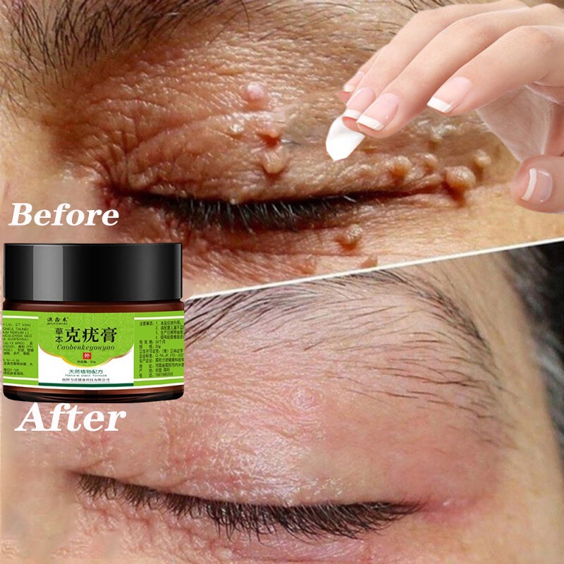 Obat Mata Ikan Penghilang Tahi Lalat Wart Removal 20g Repair And Clean Skin Tag Remover Di Wajah Menghilangkan pada mata/ wajah/ leher/ bagian tubuh/ Kapalan Di Tangan Dan Kaki Krim Antibakteri Krim Penghilang Kutil