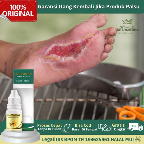 Obat Luka Diabetes, Obat Pengering Luka Diabetes Bernanah, Obat Herbal Luka Diabetes Basah, Obat Luk