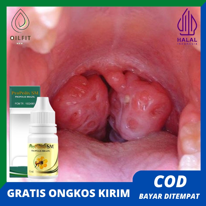 Obat Khusus Amandel Herbal Untuk Anak Dan Dewasa Pengempes Amandel Radang Tenggorokan Suara Serak