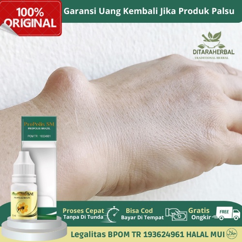 Obat Benjolan Di Tangan, Obat Benjolan Pergelangan Tangan, Obat Kista Ganglion, Obat Benjolan Keras,