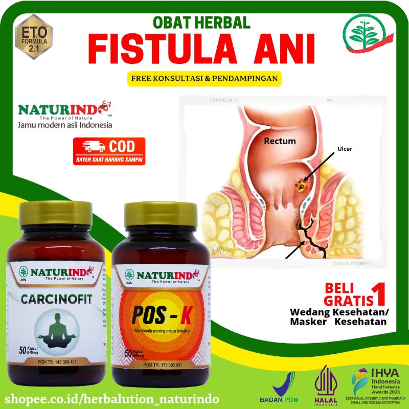 Obat Fistula Ani Ampuh Bisul Ampuh Di Pantat Bisul Bernanah Abses Perianal Fistula Ani Original Abse