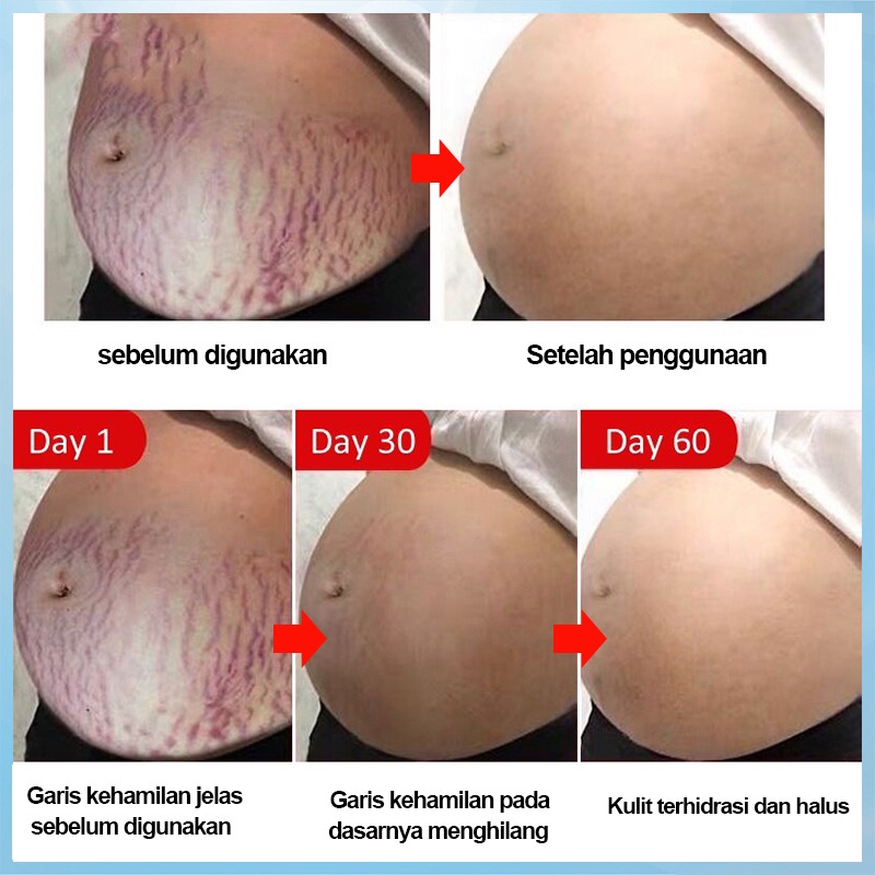 Strechmark Cream Pregnancy Cream Krim Stretch Mark Penghilang Strechmark 60g Krim penghilang bekas luka Krim perbaikan kerut untuk wanita hamil untuk memudarkan luka bakar dan luka bedah untuk menghilangkan bekas luka abadi Perawatan Tubuh