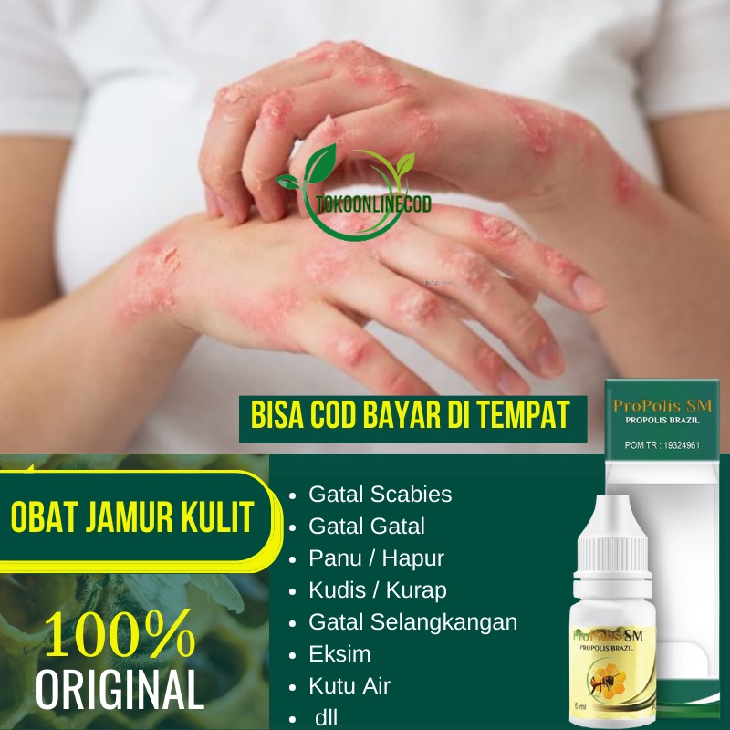 Obat Penghilang Scabies , Obat Gatal Scabie Anak , Gatal Scabies Untuk Anak | PROPOLIS SM