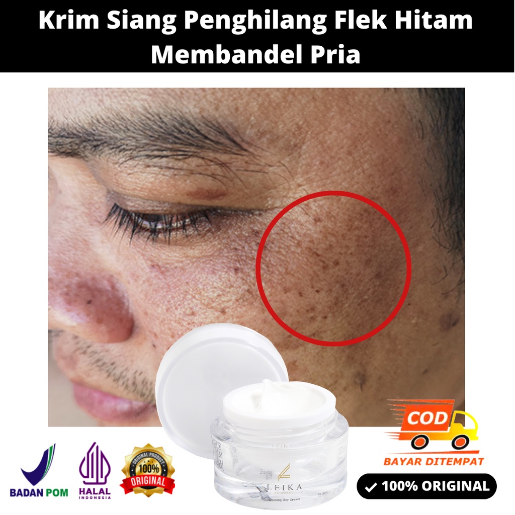 Cream Penghilang Flek Hitam Penghilang Flek Hitam Di Wajah Ampuh Bpom Krim Flek Hitam Membandel Meng