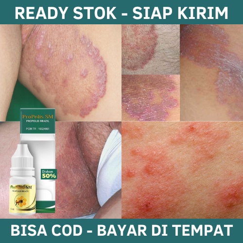 Obat Selangkangan Hitam, Obat Gatal Selangkangan, Salep Gatal Selangkangan, Obat Tetes Herbal Penghi