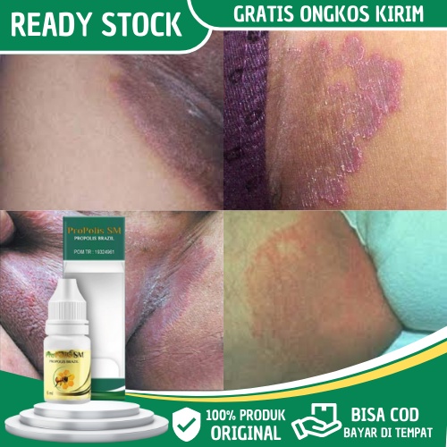 Obat Selangkangan Hitam Dan Gatal, Obat Gatal Selangkangan Pria Wanita, Obat Jamur Kulit Selangkanga