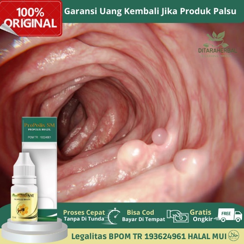 Obat Tetes Polip Rahim, Obat Benjolan Dinding Rahim, Obat Polip Rahim menahun, Obat Penghilang Polip