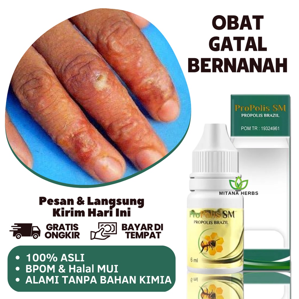 Obat Gatal Bernanah - Obat Budug Bernanah - Obat Budug Kulit Gatal - Obat Budukan - Penghilang Buduk