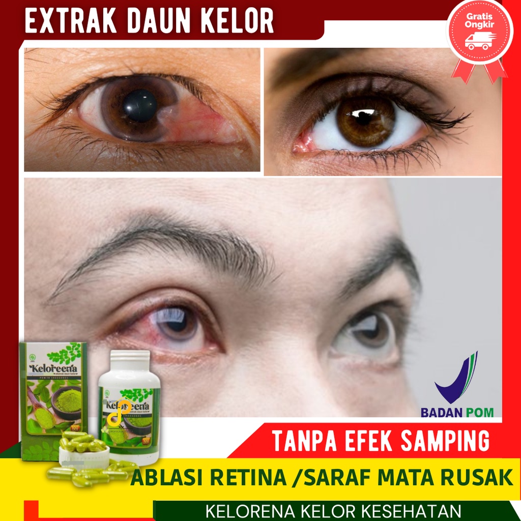 Obat Ablasi Retina, saraf Mata Berlemak / obat bintik pada mata, Obat Pemutih Mata Kuning, Kelorena 