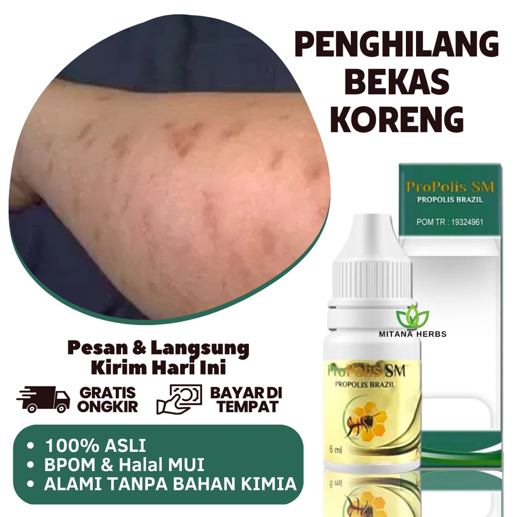 Penghilang Bekas Luka Hitam - Penghilang Bekas Luka Lama - Penghilang Bekas Luka Hitam Koreng Di Kak