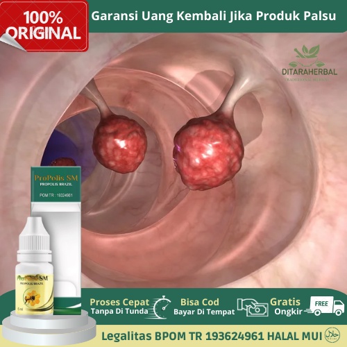 Obat Polip Hidung, Obat Benjolan Polip Hidung, Obat Herbal Polip Hidung Menahun, obat Penghilang Ben