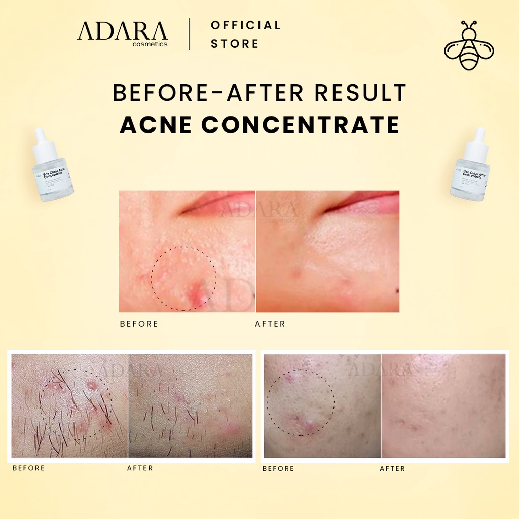 ADARA Bee Clear Acne Concentrate | Serum