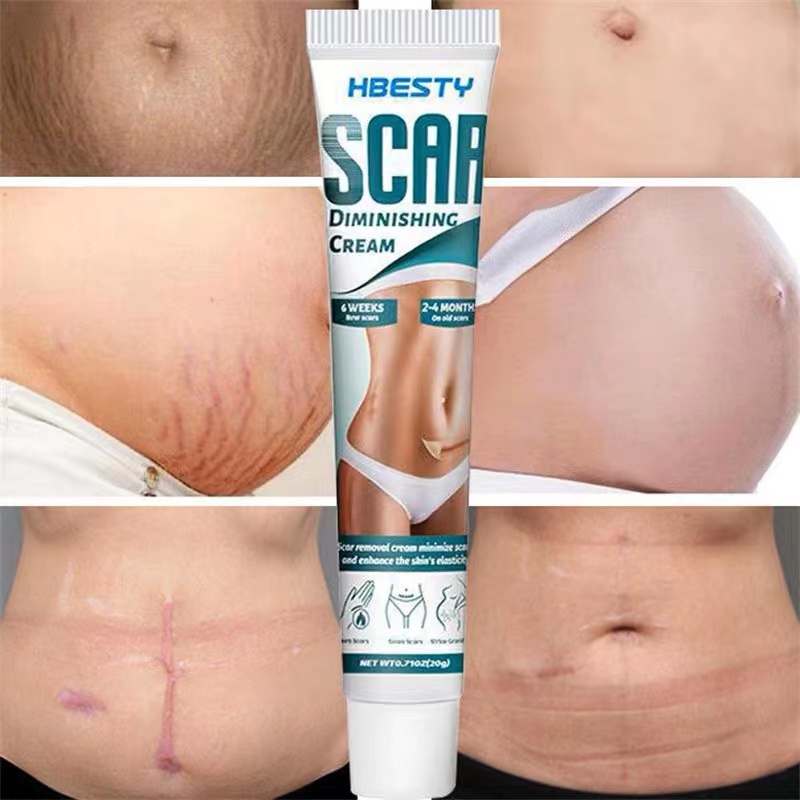 Cream penghilang bekas luka Menghilangkan bekas luka Salep penghilang bekas luka 20g Bekas jerawat/bekas luka bakar/bekas luka operasi/bekas luka operasi caesar/stretch mark/Permanen / Original / Cocok untuk orang di atas 6 tahun