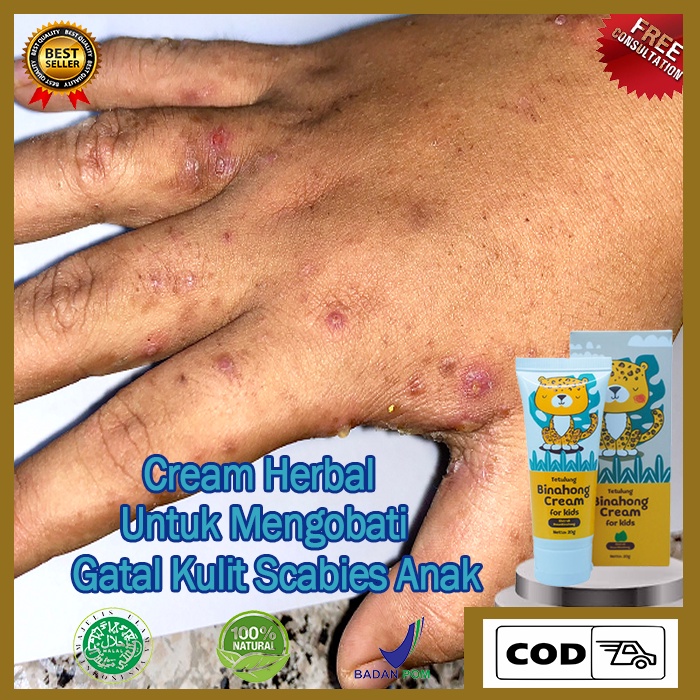 Salep Kulit Anak Scabies, Cream Oles Untuk Bayi Yang Terkena Gatal Akibat Bakteri Scabies, Koreng Ga