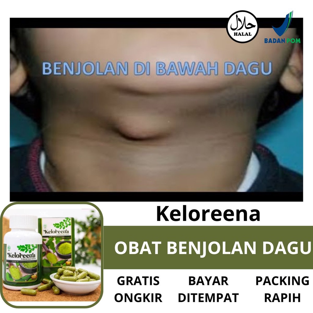 Obat Benjolan Di Bawah Dagu - Penghilang Penyakit Benjolan Bengkak Nyeri Dibawah Jakun, Penghancur K