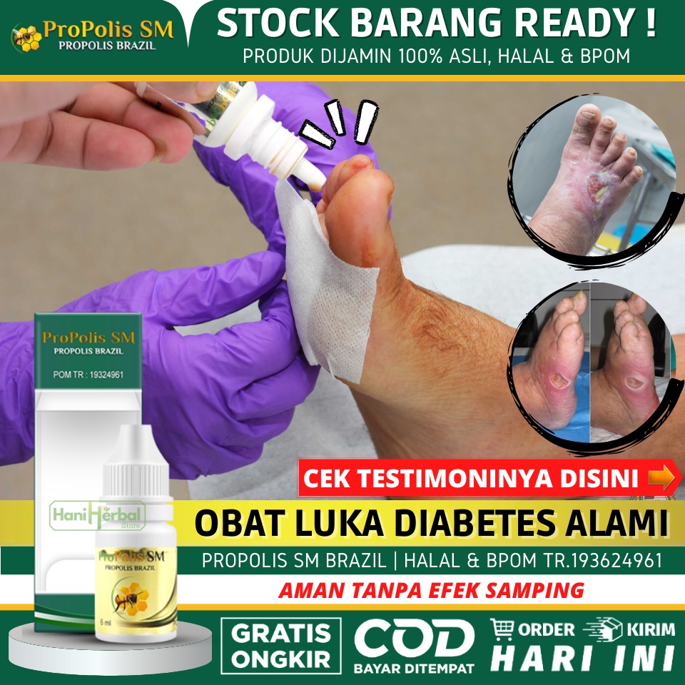 Obat Oles Luka Diabetes Alami, Salep Luka Diabetes, Obat Luka Gangren Diabetes, Obat Luka Basah Diab