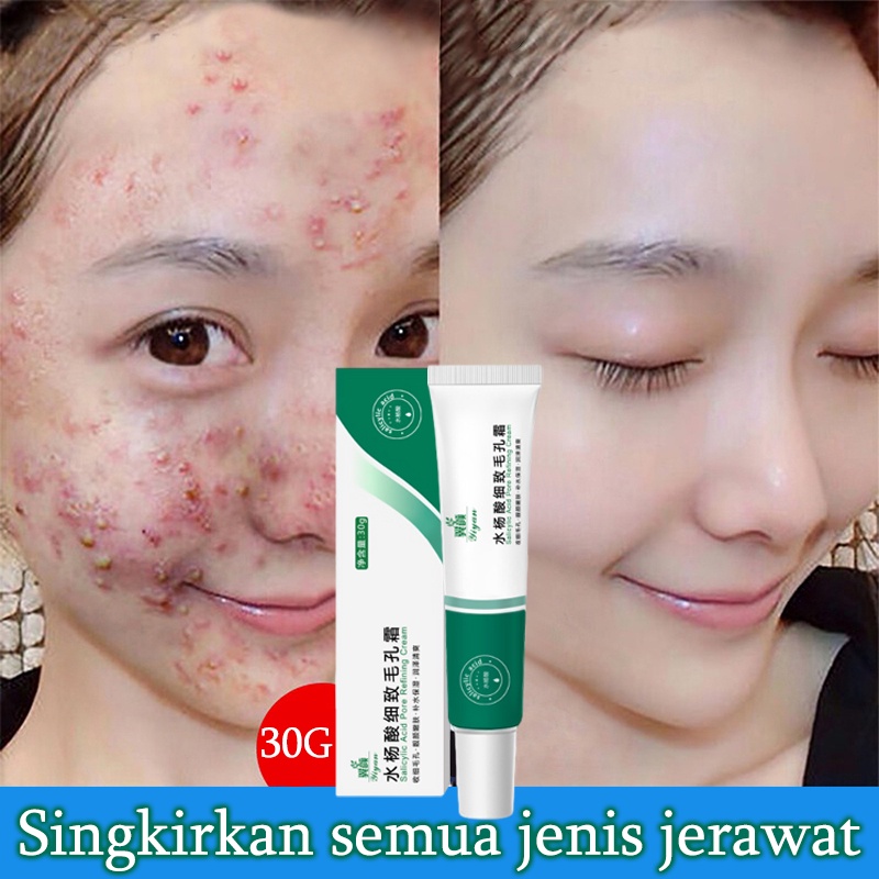 Acne gel jerawat Mengecilkan Pori pori besar Serum wajah 30G Menyegarkan kontrol minyak komedo mengecilkan pori-pori Meningkatkan jerawat dan kulit kasar Melembabkan dan meremajakan Menghilangkan jerawat, komedo, pori-pori besar