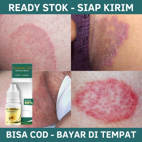 Obat Selangkangan Gatal Dan Hitam, Obat Gatal Selangkangan, Obat Gatal Selangkangan Gatal Dan Hitam,