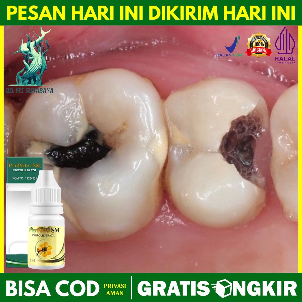 Cara Mudah Mengobati Sakit Gigi Berlubang Sampai Tuntas 1-5 Menit Cepat Sembuh