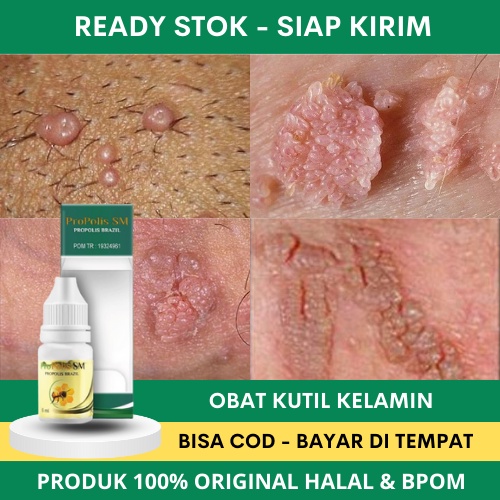 Obat Kutil Kelamin, Obat Kutil Kelamin Laki Laki, Obat Kutil Kelamin Wanita, Obat Kutil Kelamin HPV,