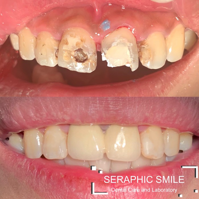 TERLARIS- Gigi Palsu Metal Porselen / Jacket Crown / Pelindung Gigi Rusak (NEW)