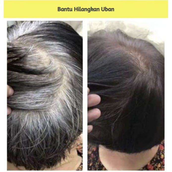 Smuuty Hair Treatment Penyubur Rambut Mengatasi Rambut Rontok Menghilangkan Ketombe Penghilang Uban Khusus Pria dan Wanita Terbukti Ampuh Cepat Atasi Masalah Rambut