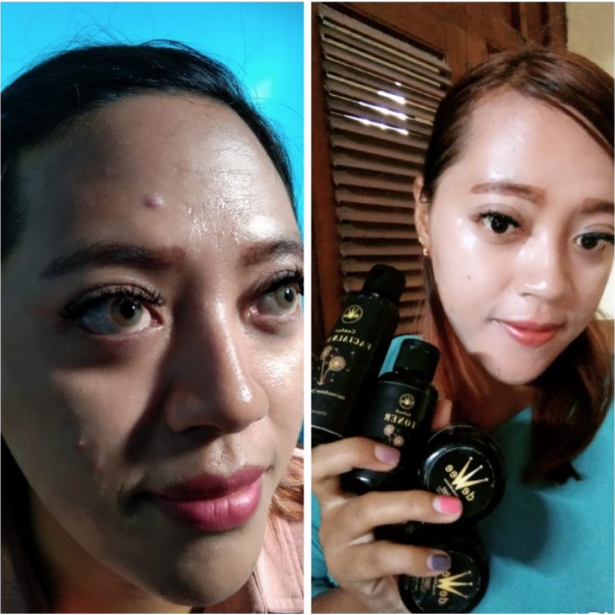 BEST SELLER Paket DEWEE BANDEL FLEK PARAH ACNE JERAWAT PARAH Cream Dewee Skincare Beauty FREE GIFT G