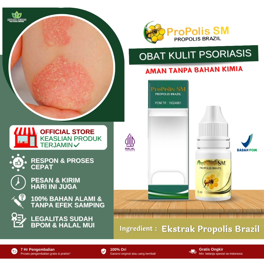 Obat Psoriasis Kulit Kepala - Obat Psoriasis Kulit - Obat Psoriasis Salep Prosiriasis Salep Anti Gat