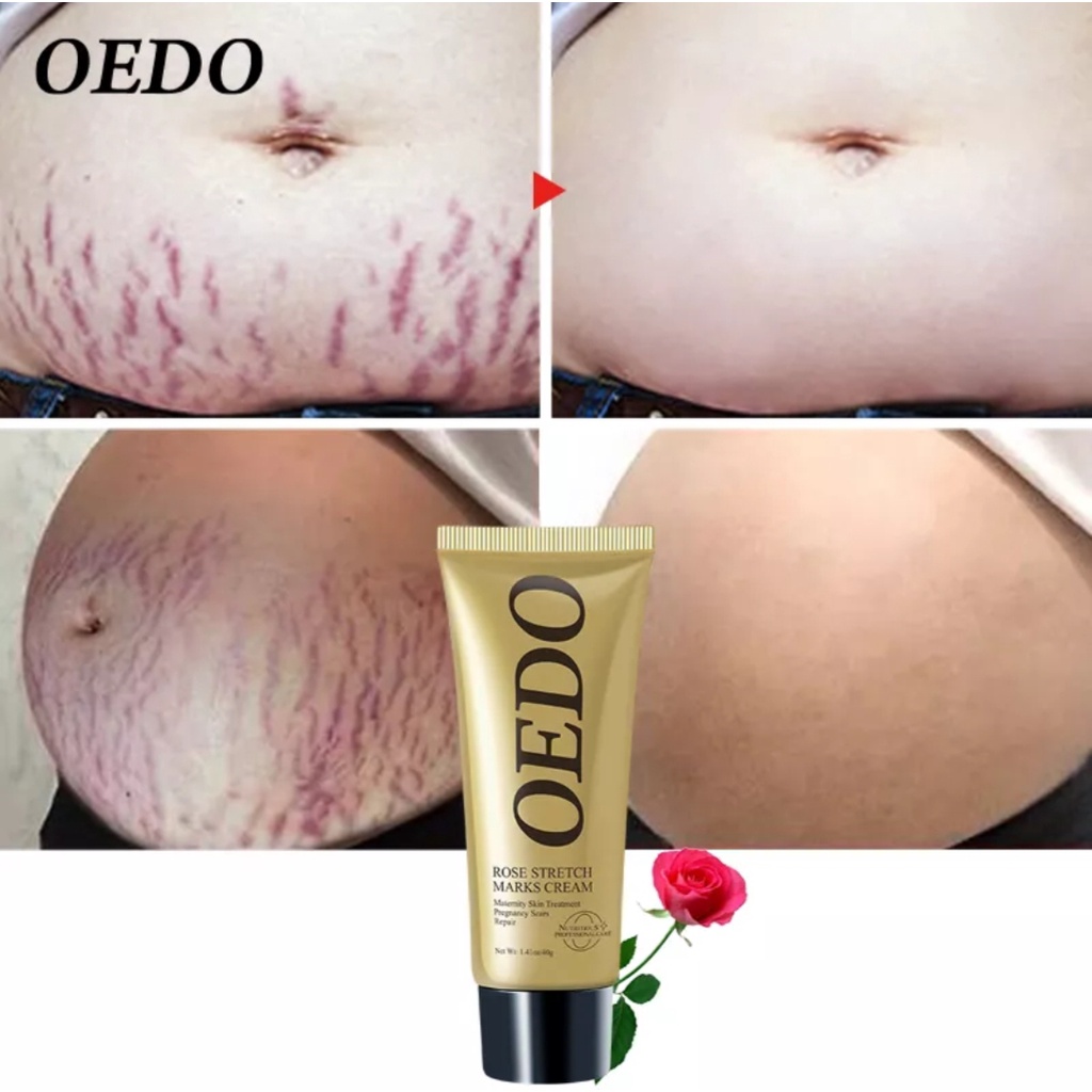 ORI 100% OEDO KRIM PENGHAPUS STRETCH MARKS PERUT PAYUDARA KAKI/KRIM BERSALIN MENGHILANGKAN BEKAS MEL