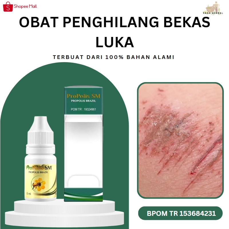 Kaka Herbal - Obat Penghilang Bekas Luka, Penghilang Bekas Luka Korengan, Obat Koreng Gatal, Obat Ko