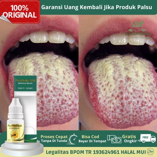 Obat Tetes Lidah Putih, Obat Lidah Berjamur, Obat Candidasis Mulut, Obat Bercak Pada Lidah, Obat Rad