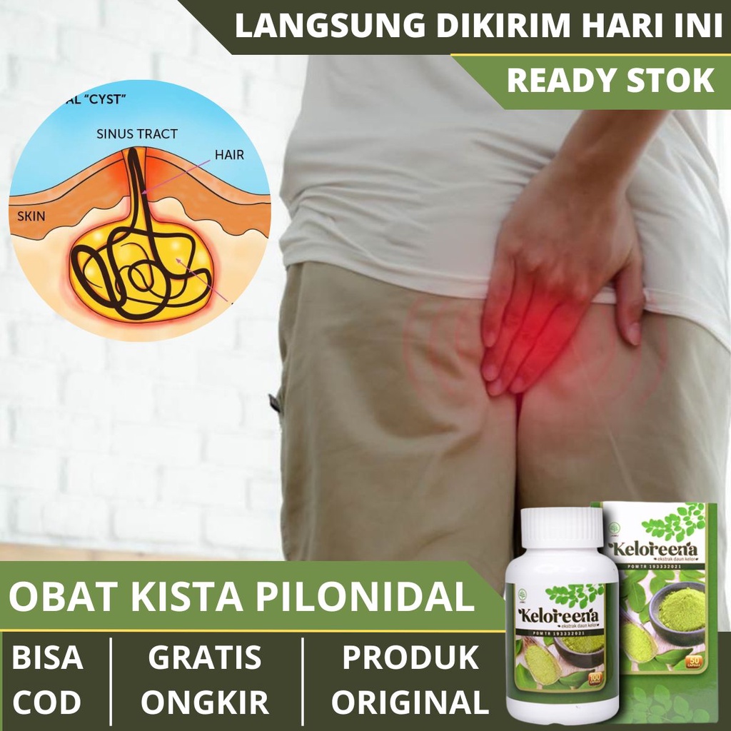 Obat Kista Pilonidal - Penghancur Kista, Bisul, Abses, Infeksi, Tumor Pada Bokong, Penghilang Benjol