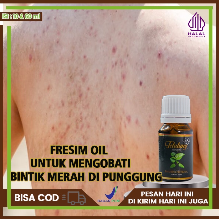 Obat Kulit Bintik Merah Di Punggung , Obat Gatal Jerawat Punggung, Obat Bruntusan Di Punggung, Obat 