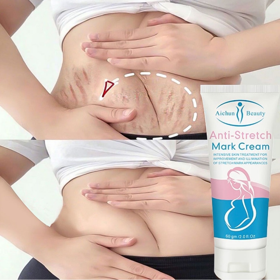 AICHUN Anti-Krim Stretch Mark Cream/Maternity Repair Body Cream-Menghilangkan Stretch Mark Penghilang Bekas Luka, Memperbaiki, Melembabkan -60g