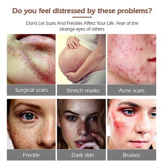 [COD] Original PENGHILANG BEKAS LUKA Penghilang Bekas Luka / Penghilang bekas luka Ekstrak tumbuhan salep luka bakar penghilang bekas jerawat mengembalikan