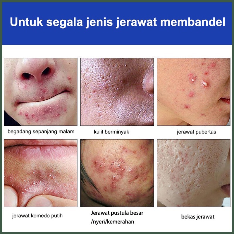 Penghilang jerawat Serum Gel jerawat Perawatan jerawat wajah Serum wajah acne 20G Menghilangkan jerawat, Bekas jerawat, Memudarkan bekas jerawat Esensi herbal Dengan lembut, aman dan cepat menghilangkan semua jenis jerawat dan bekas jerawat