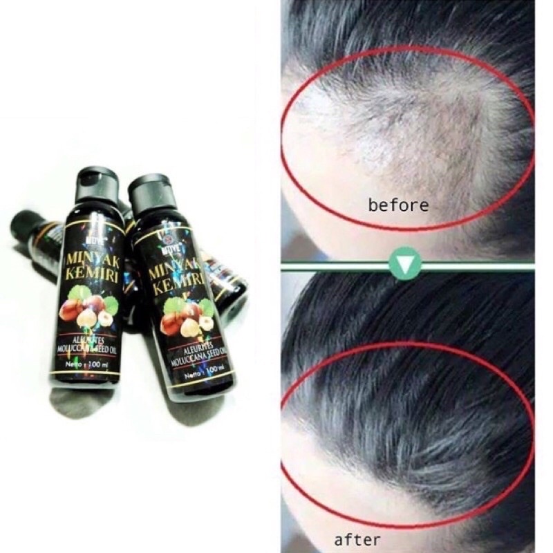 100ml Minyak Kemiri Hitam Murni / Penumbuh Rambut Botak Rontok / Penumbuh Brewok