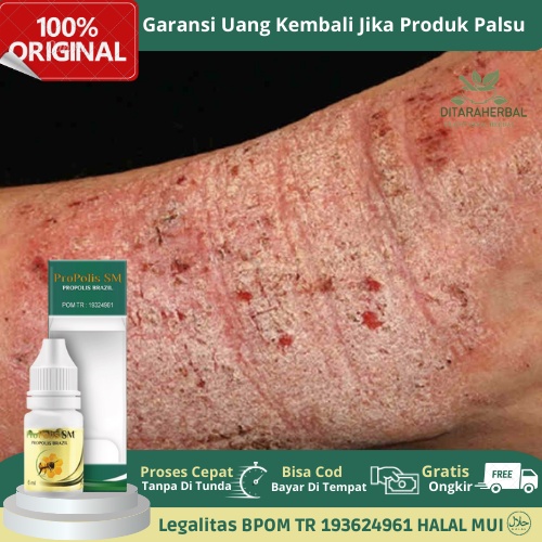 Obat Gatal Eksim Menahun, Obat Kulit Eksim, Obat Tetes Kulit Eksim, Obat Eksim Basah, Obat Eksim Ker