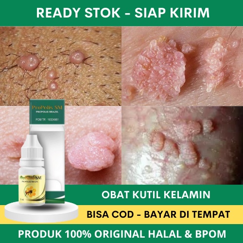 Obat Kutil Kelamin, Obat Kutil Kelamin Laki Laki, Obat Kutil Kelamin HPV, Obat Kutil Kelamin Wanita