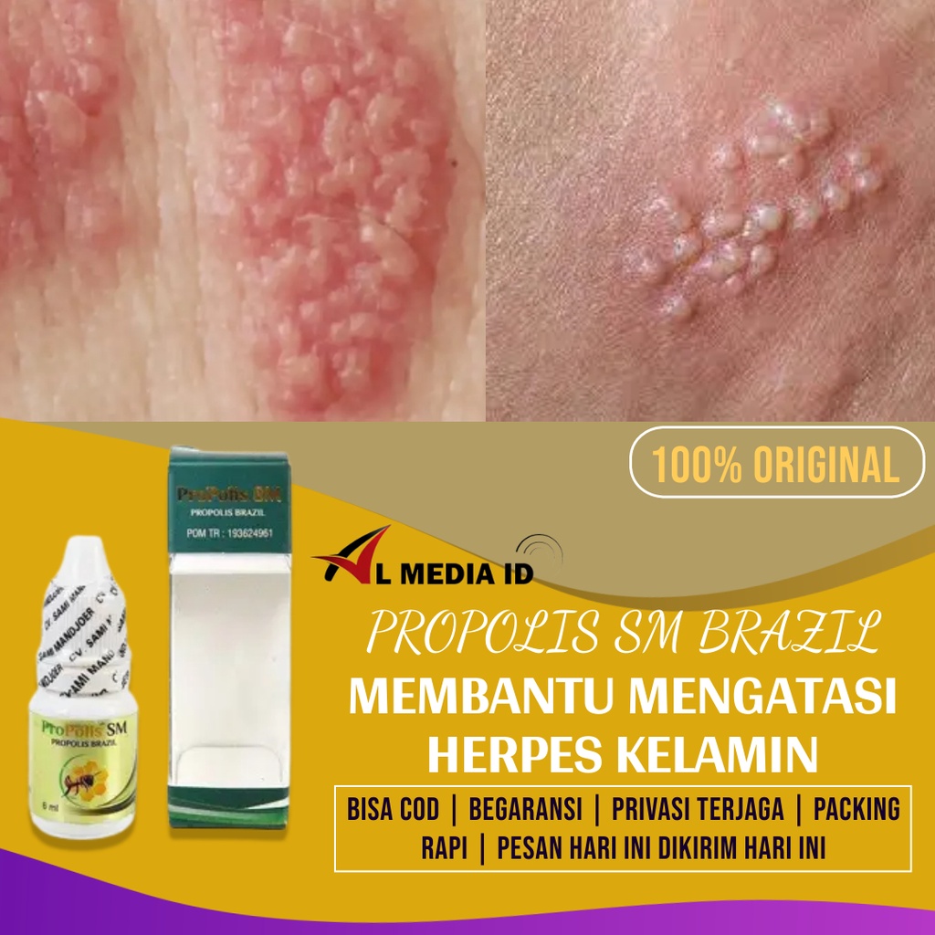 Obat Herbal Herpes Genital Aman, Obat Herpes Kelamin Pria Atau Wanita Propolis Sm Untuk Herpes Akut 