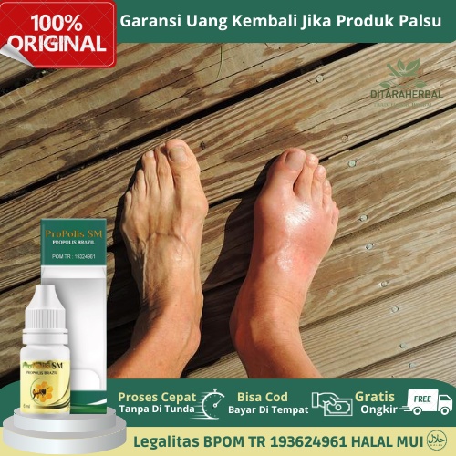 Obat Nyeri Kaki Bengkak, Obat Kaki Bengkak, Obat Betis Bengkak, Obat Kram Otot Betis Bengkak, Obat K