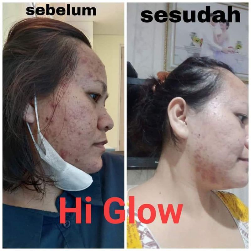 HI GLOW SKINCARE PAKET ACNE PRONE