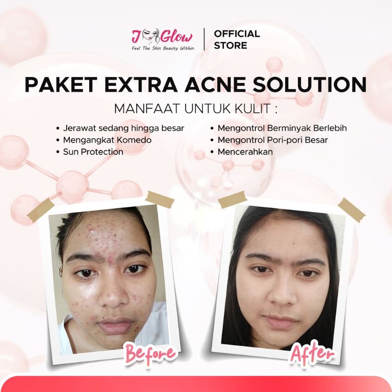 Jglow Skincare Paket Acne Solution Sulfur Whitening / Rangkaian Skincare Glowing Untuk Perawatan Wajah Berjerawat Meradang Bernanah dan Jerawat Batu