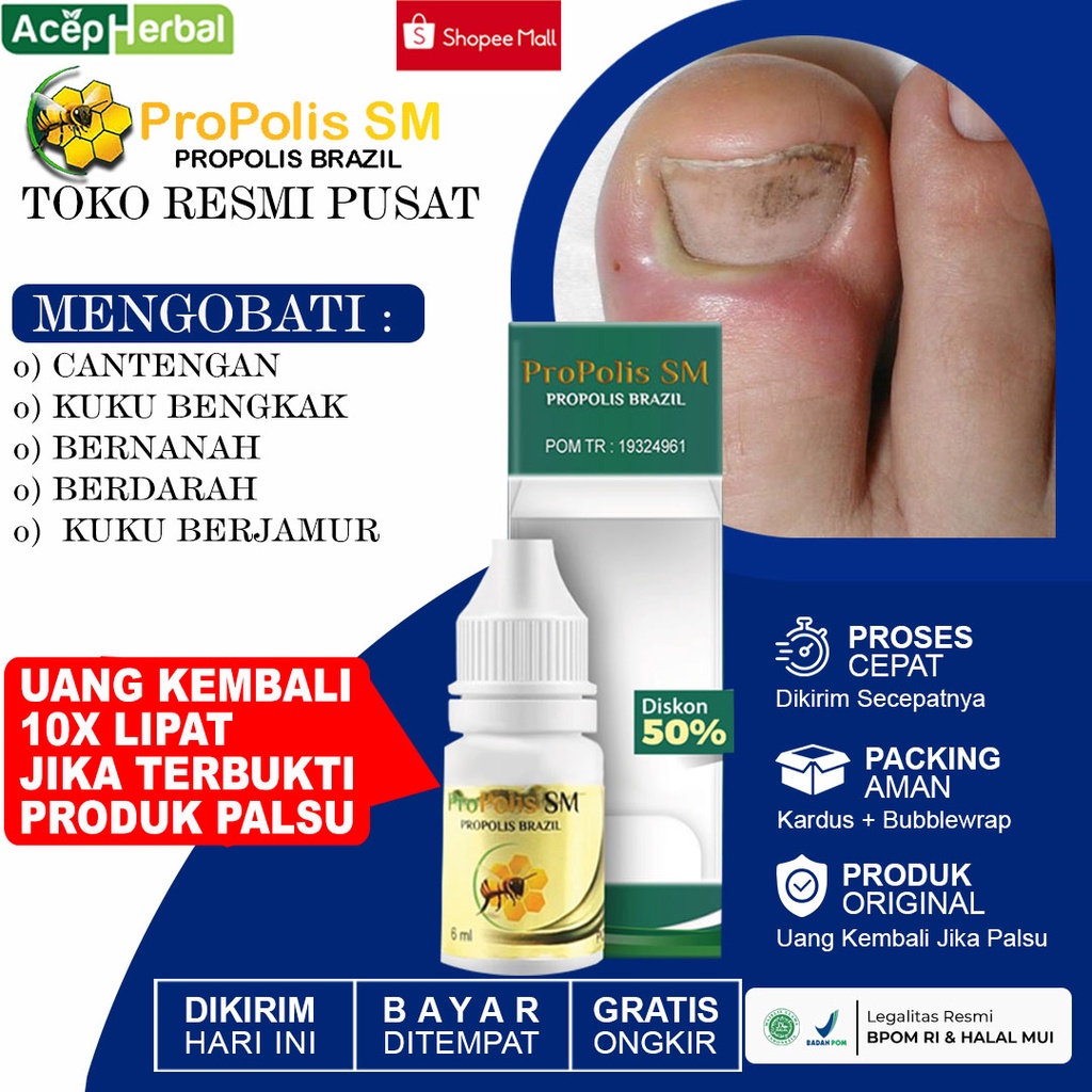 Obat Cantengan Jempol Kaki Bengkak Bernanah Kuku Berjamur Penghilang Kuku Jamuran Propolis SM