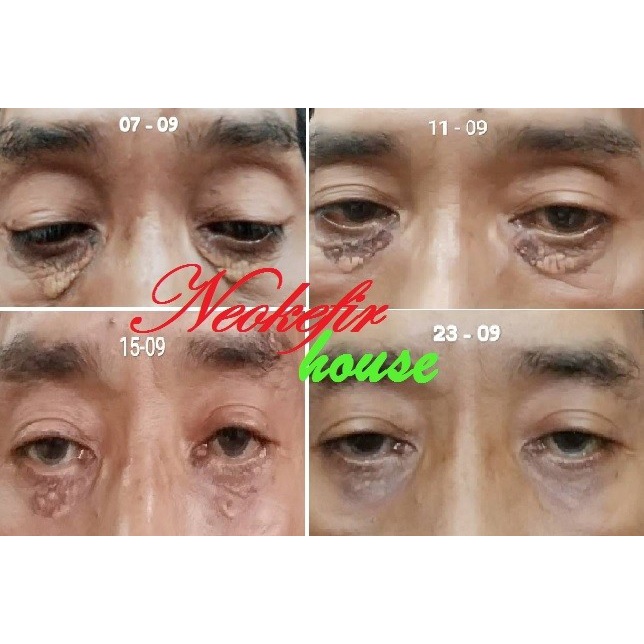 Paket Xanthelasma Cream 10gr
