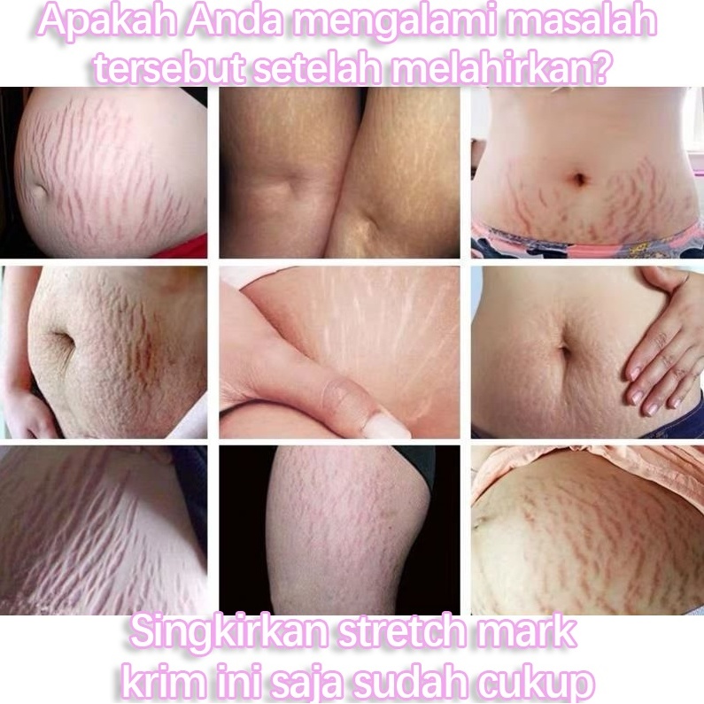 AICHUN Anti-Krim Stretch Mark Cream/Maternity Repair Body Cream-Menghilangkan Stretch Mark Penghilang Bekas Luka, Memperbaiki, Melembabkan -60g