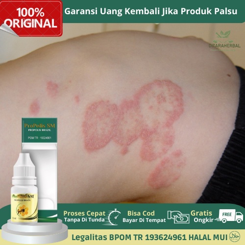 Obat Kudis, Obat Panu, Obat Herbal Scabies Manusia, Obat Gatal Pada Tubuh Akibat Kudis Panu, Obat Be