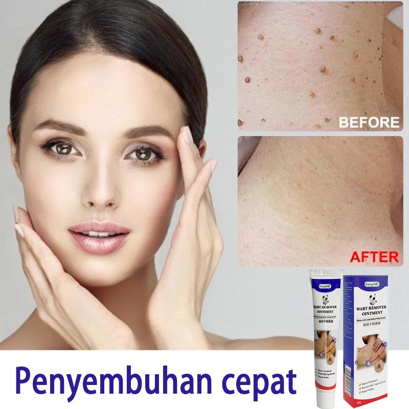 [100% ORI] Wart Remover Cream penghilang kutil Repair And Clean Skin Tag Remover 20g Obat Skin Tag di leher, Wajah, papiloma, kondiloma, kutil dan tahi lalat Menghilangkan Bpom Bahan botani alami, aman tanpa rasa sakit, tanpa efek samping