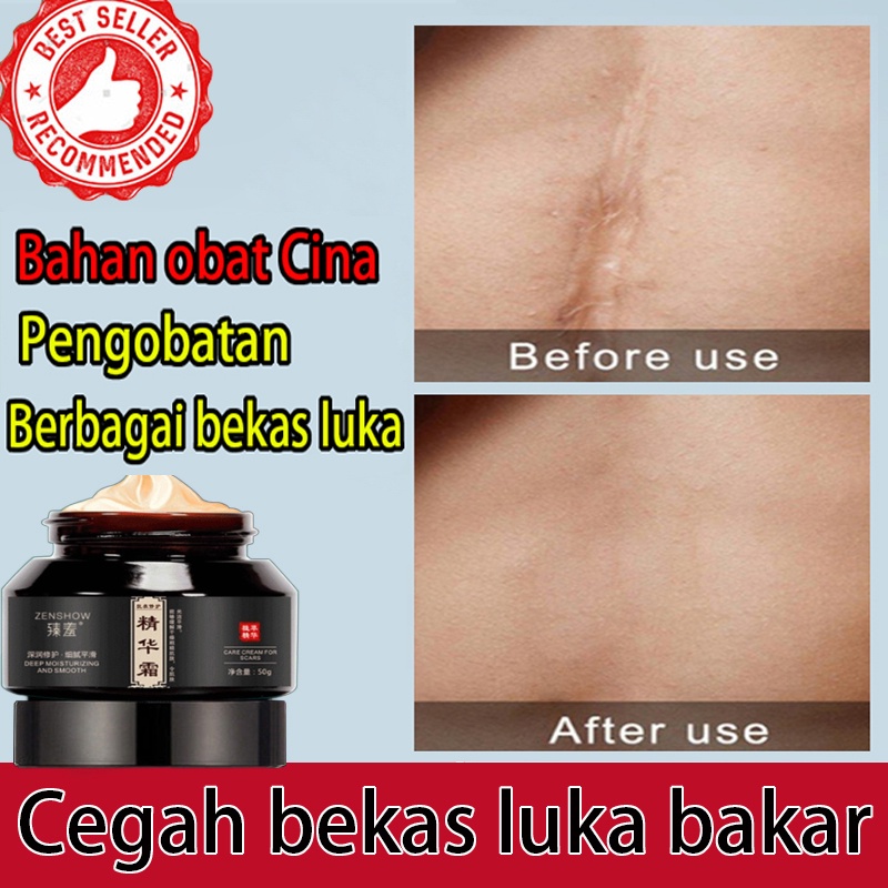 [COD] Original PENGHILANG BEKAS LUKA Penghilang Bekas Luka / Penghilang bekas luka Ekstrak tumbuhan salep luka bakar penghilang bekas jerawat mengembalikan